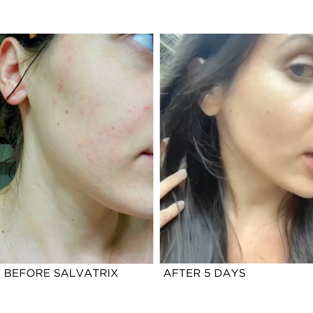 Before and after results using Salvatrix anti blemish serum, showing improvement in skin texture after 5 days.